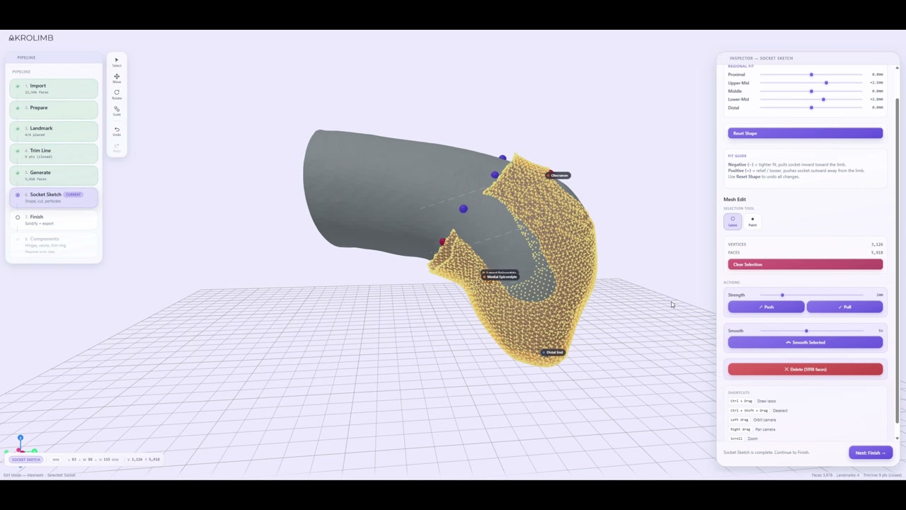 Akrolimb Transradial socket software — mesh editing and fit inspector